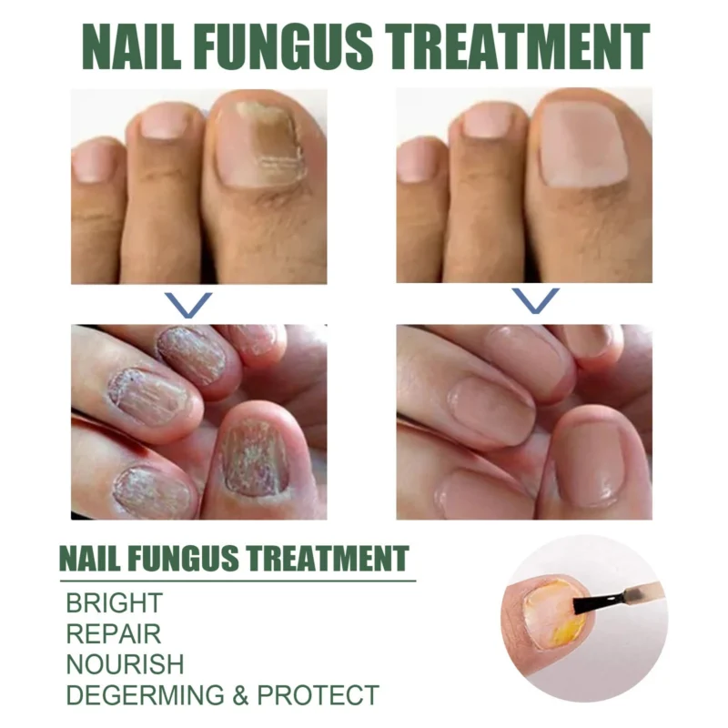 Eelhoe Nail Fungus Treatment Repair Liquid Roz P8xveqt2 2