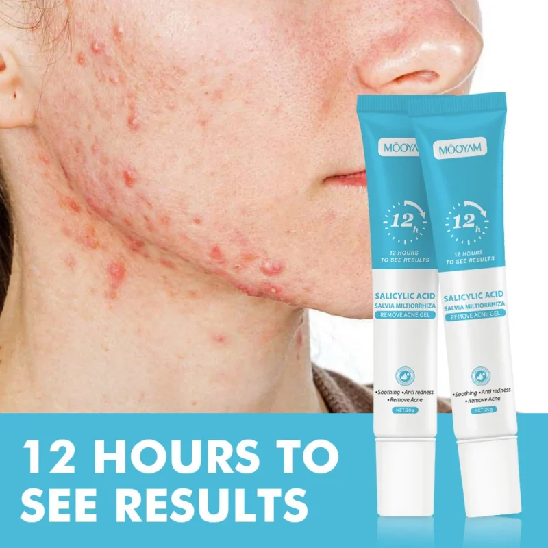 Salicylic Acid Acne Gel - MOOYAM 12-Hour Rapid Action Pimple Treatment & Pore Minimizer with Salvia Miltiorrhiza (20g)